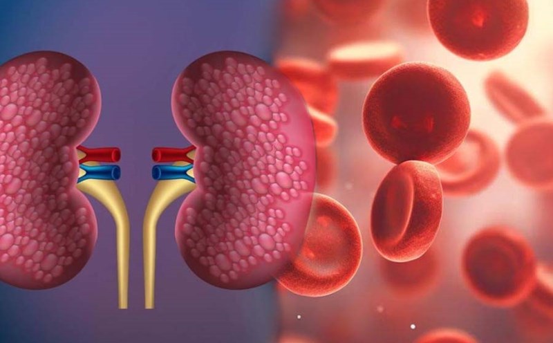 Chronic kidney disease can cause anemia. Graphics: Thien Nhan