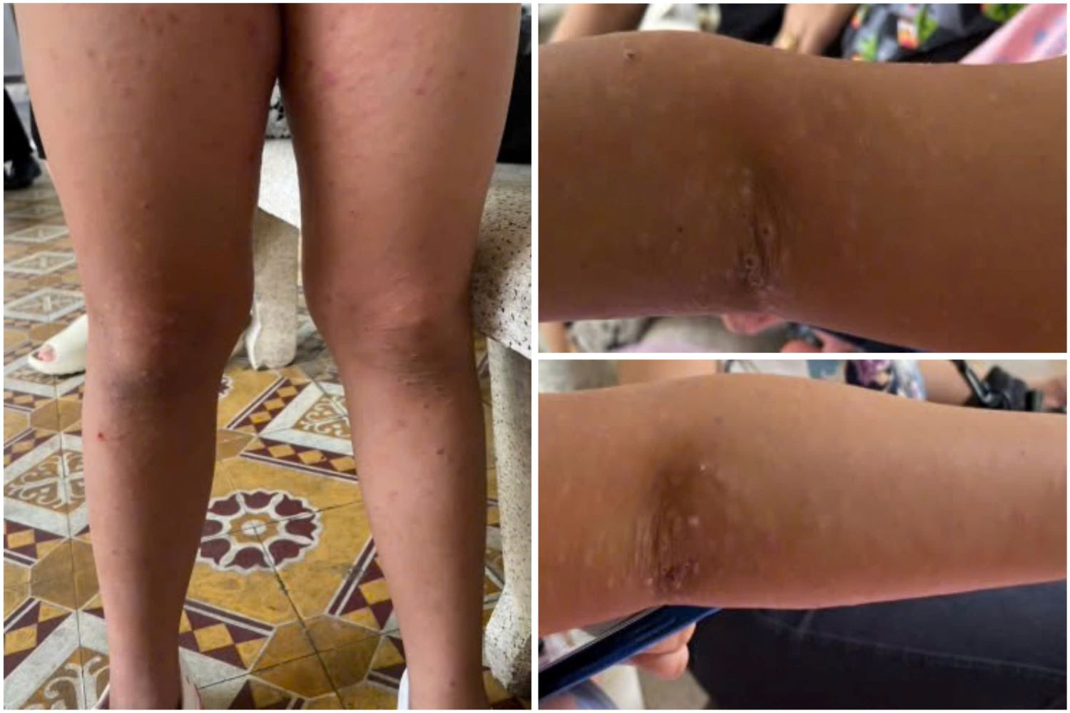 Acrodermatitis in children. Photo: Provided by the hospital