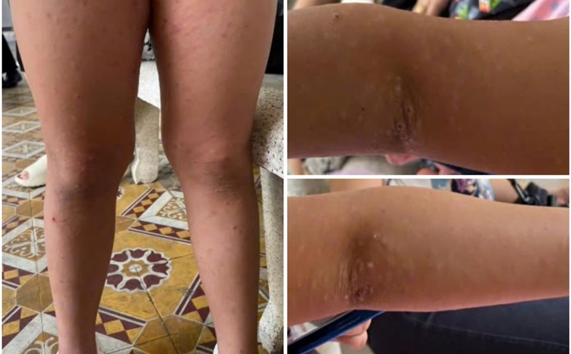 Acrodermatitis in children. Photo: Provided by the hospital