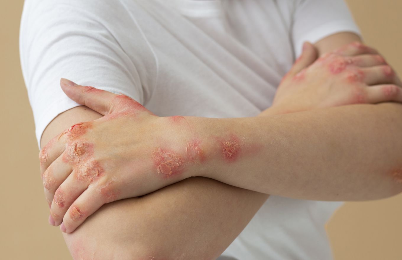 Shingles causes the skin to become eroded, ulcerated, ooze a lot of fluid and form scabs. Photo: Freepik