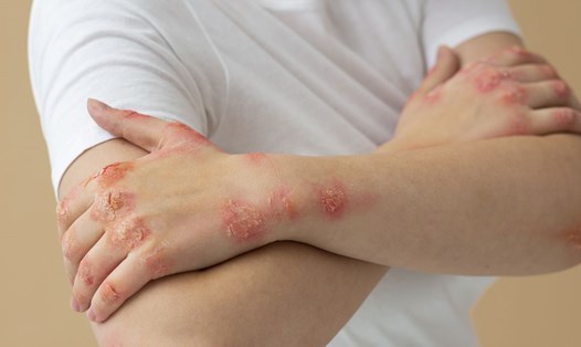 Zona thần kinh khiến da trợt, loét, rỉ nhiều chất dịch và đóng mài. Ảnh: Freepik