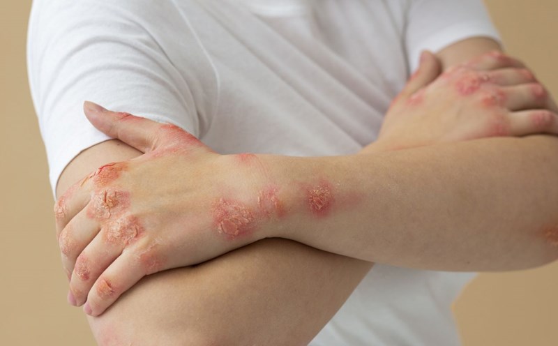 Shingles causes the skin to become eroded, ulcerated, ooze a lot of fluid and form scabs. Photo: Freepik