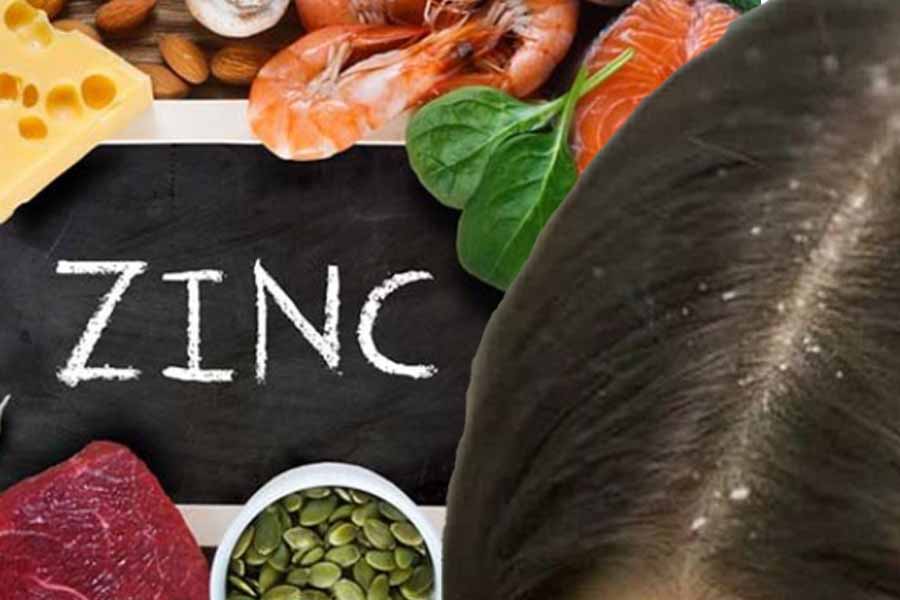 Benefits of zinc help to clear dandruff on hair. Graphics: Thien Nhan