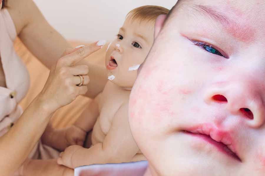 How to control eczema in cold weather at home. Photo: ONLYMYHEALTH