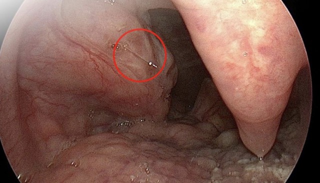 Image of fish bone stuck in the patient's right tonsil. Photo: BVCC