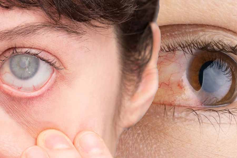 Sự khác biệt giữa đục thủy tinh thể và bệnh tăng nhãn áp. Đồ hoạ: Thiện Nhân