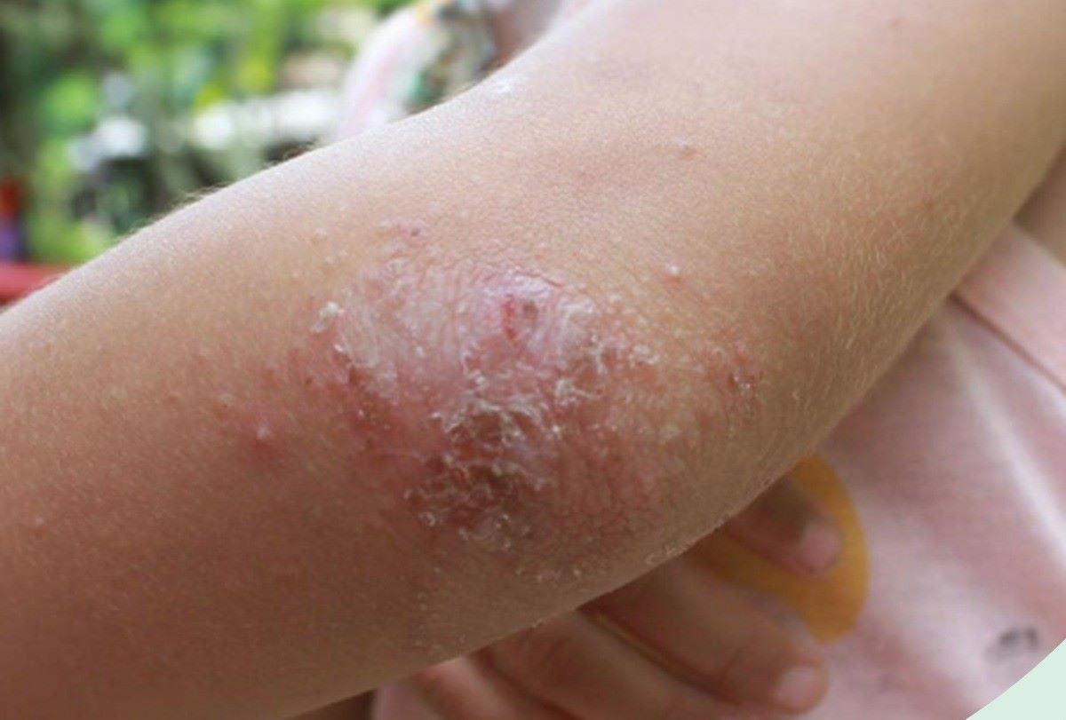 Psoriasis is a chronic disease with persistent, itchy skin lesions. Photo: Provided by the hospital