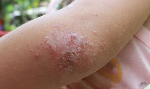 Vảy nến là bệnh mạn tính với các thương tổn ngoài da dai dẳng, ngứa. Ảnh: Bệnh viện cung cấp