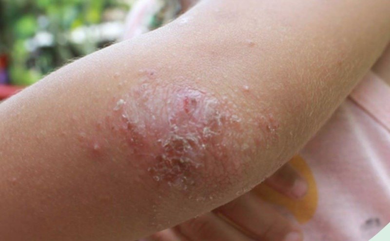 Psoriasis is a chronic disease with persistent, itchy skin lesions. Photo: Provided by the hospital