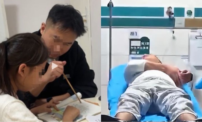 A man in Henan (China) was hospitalized while teaching his child. Photo: 163.com