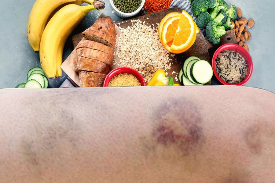 A balanced diet will help reduce the risk of bruising. Graphics: Thien Nhan