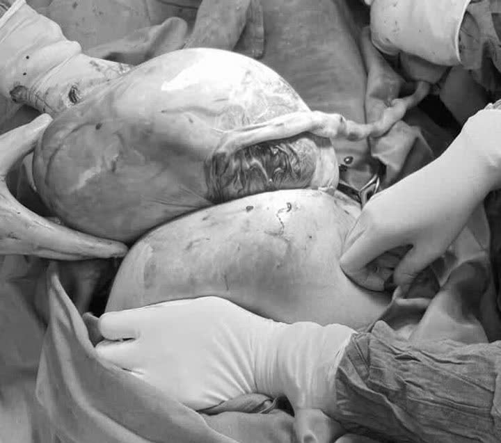 The twins were born still in their amniotic sacs. Photo: BVCC