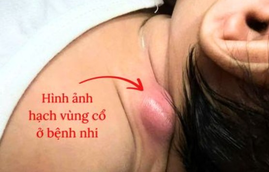 Most of the lymph nodes in the head, face and neck area in children are benign. Photo: BVCC