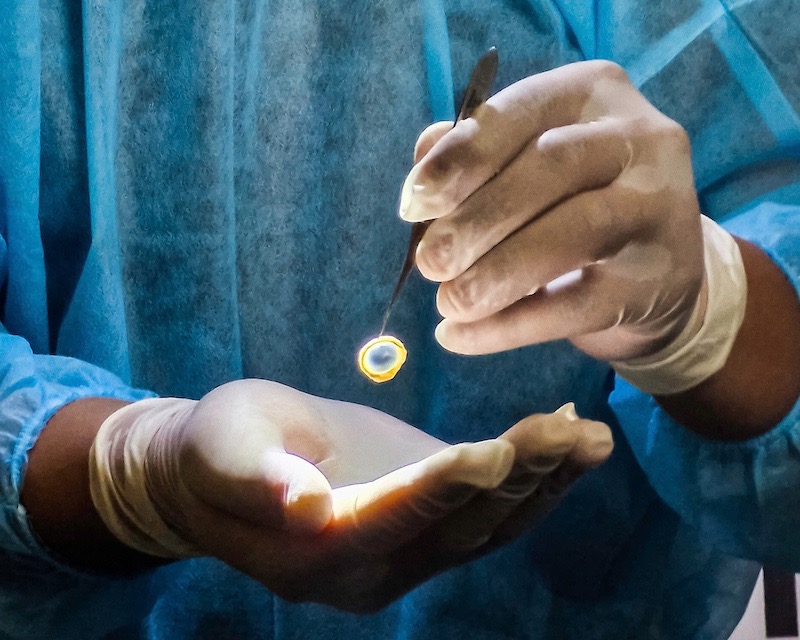 An 86-year-old man has become the first cornea donor in Hoa Binh province. Photo: BVCC