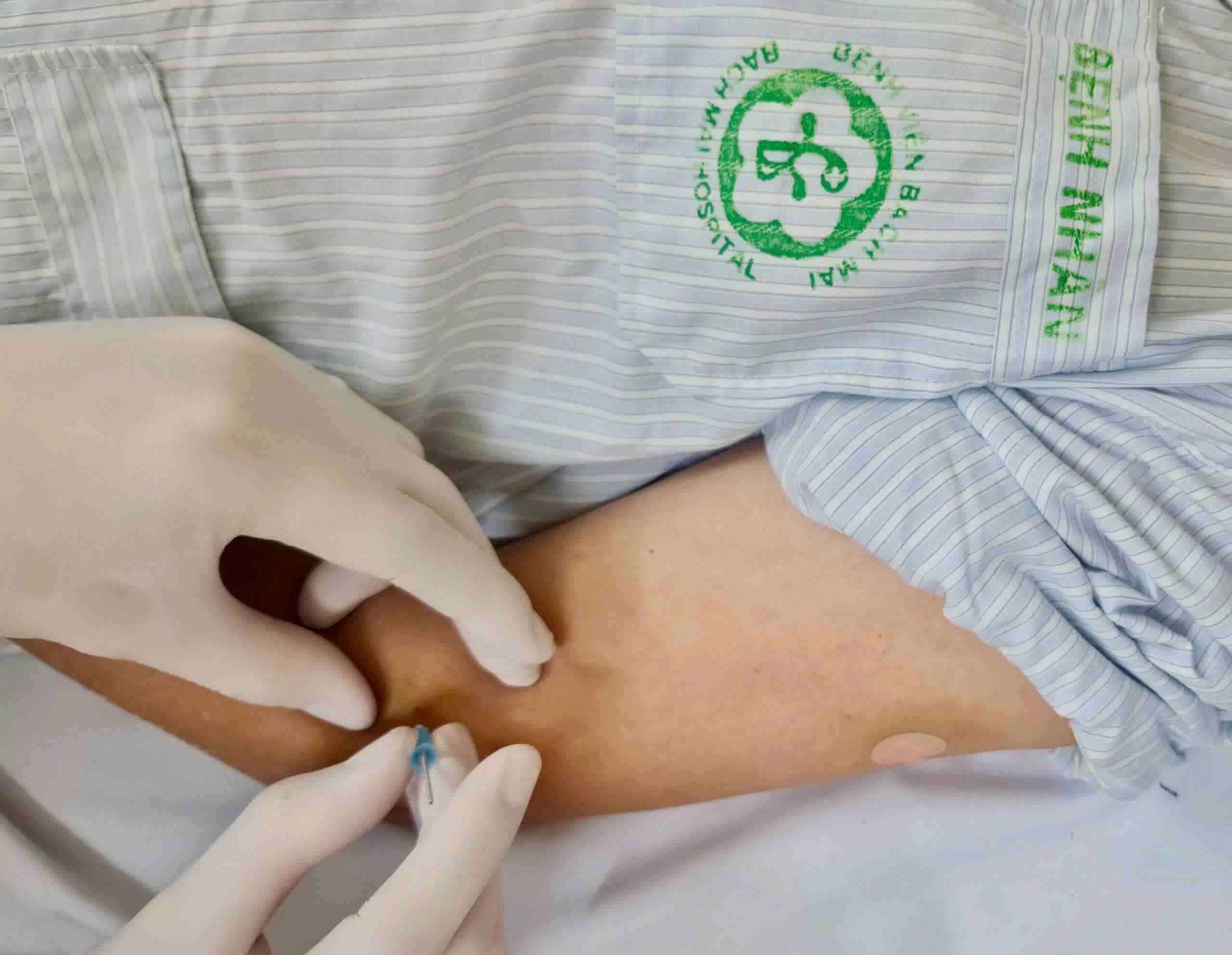 Acupuncture at the Department of Traditional Medicine, Bach Mai Hospital. Photo: Nguyen Ha