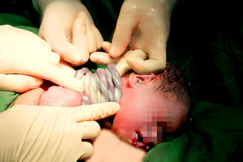 Baby girl born with 9 umbilical cords wrapped around her neck. Photo: BSCC