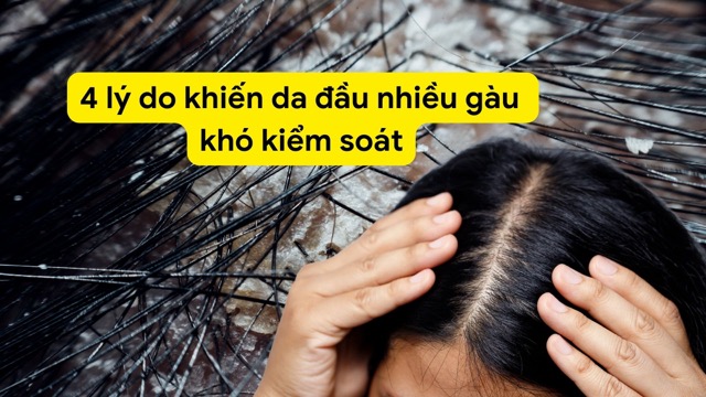 Scalp with lots of dandruff is difficult to control because of using unsuitable shampoo. Photo collage: HUONG SON