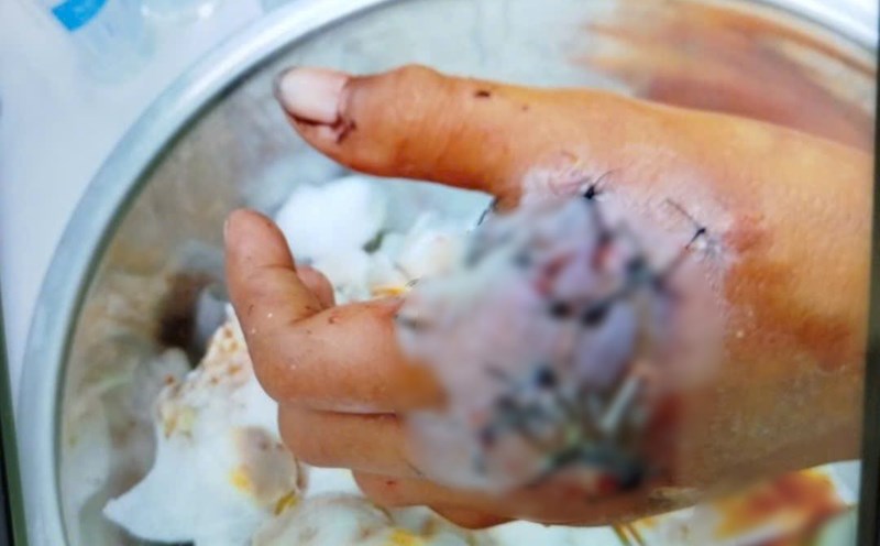 Child patient D.S.R was hospitalized due to homemade firecrackers. Photo: Provided by the hospital