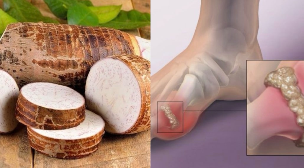 Be careful when eating taro because it can increase uric acid. Graphics: Huong Giang