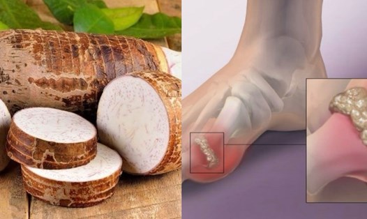 Lưu ý khi ăn khoai môn vì nó có thể tăng axit uric. Đồ họa: Hương Giang