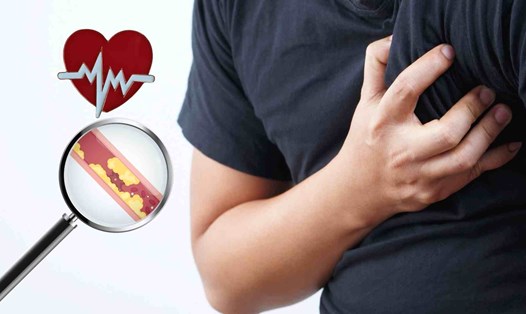 Một số dấu hiệu sau tập thể dục báo hiệu nhồi máu cơ tim, đột quỵ. Đồ họa: Hạ Mây