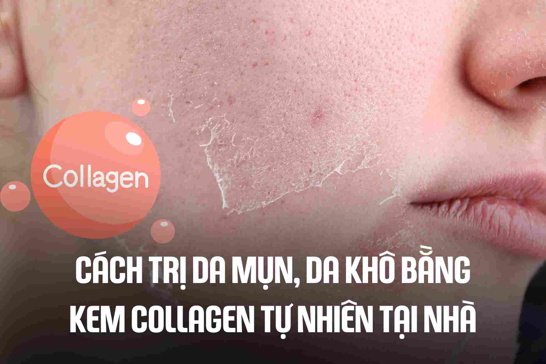 How to treat acne and dry skin with natural collagen cream at home. Graphics: Cao Thom