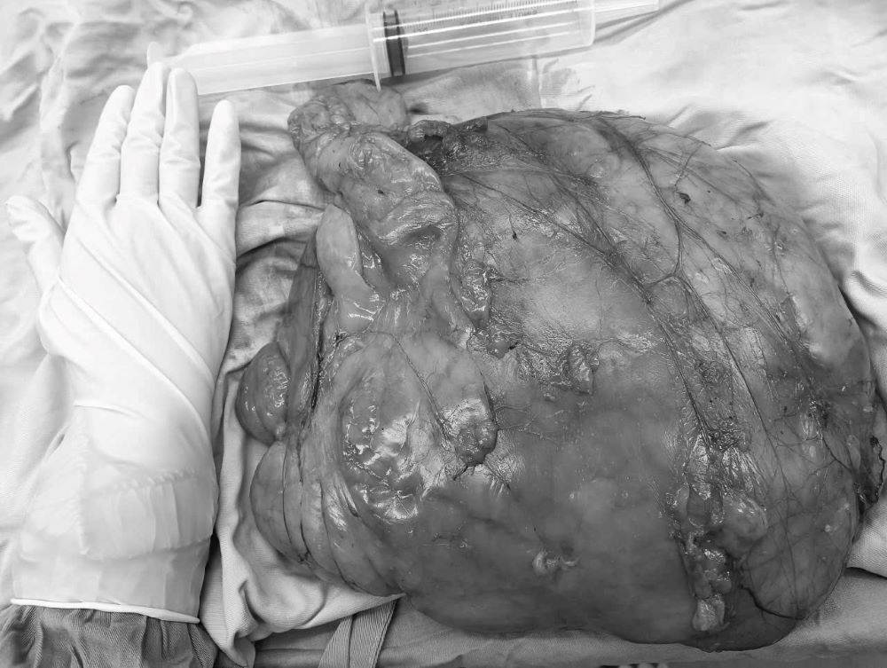 Da Nang successfully operated on a giant lipoma. Photo: BVDN