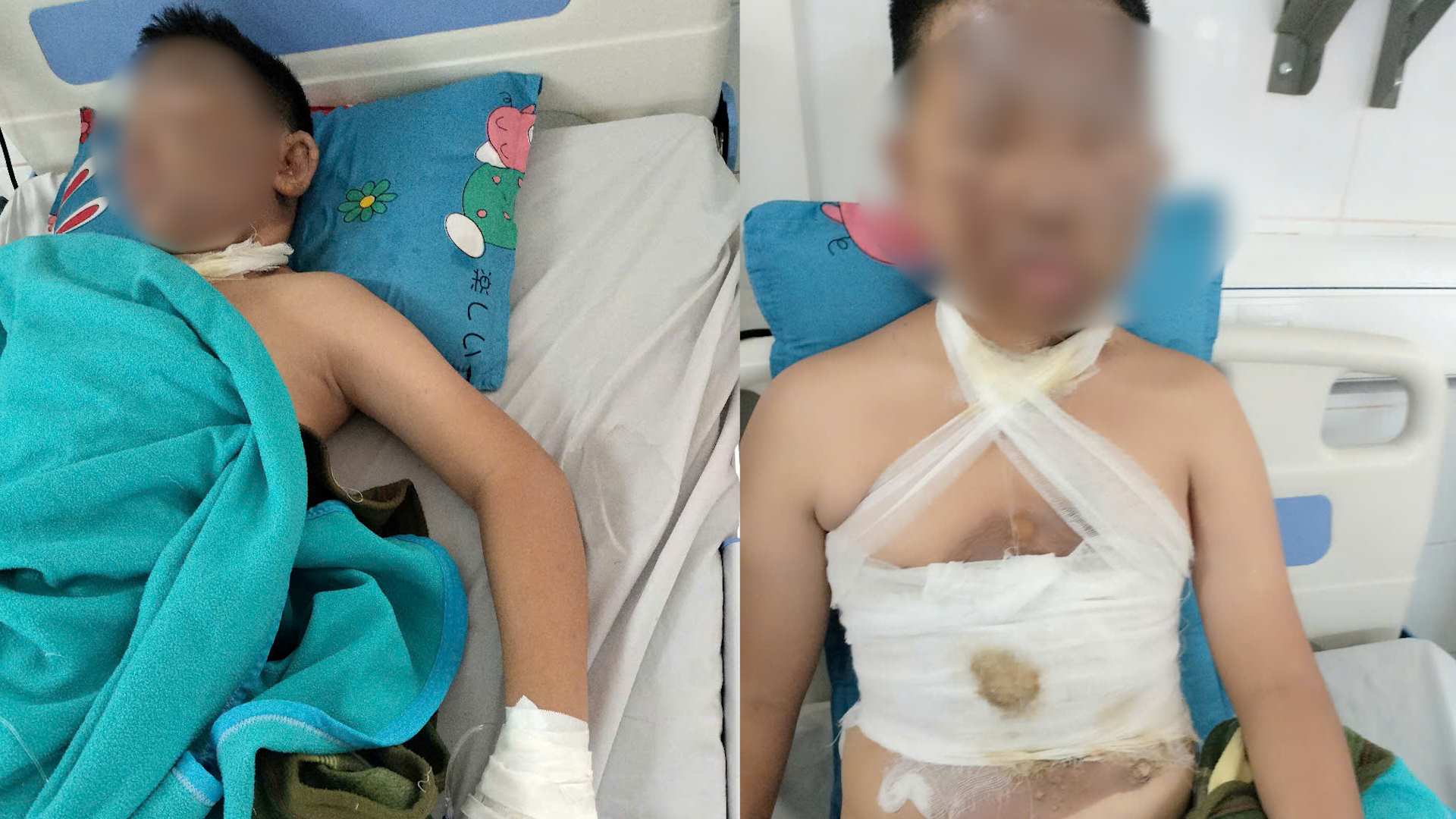Child patient R. suffered burns from homemade firecrackers at home. Photo: NGUYEN LY