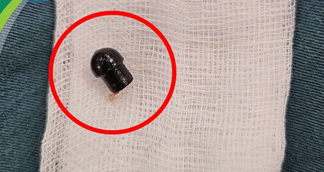 Image of a foreign object with a ballpoint pen tip removed from a child's airway. Photo: BVCC
