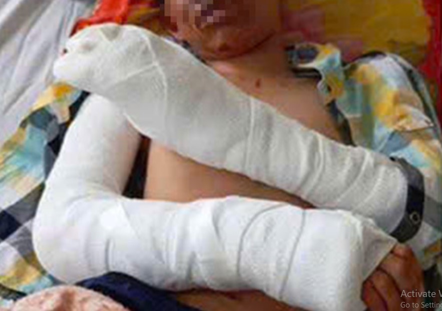 A male student in Khanh Hoa was injured while making homemade firecrackers. Photo: Phuong Linh