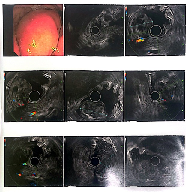 The patient had successful laparoscopic surgery. Photo: DINH CHINH