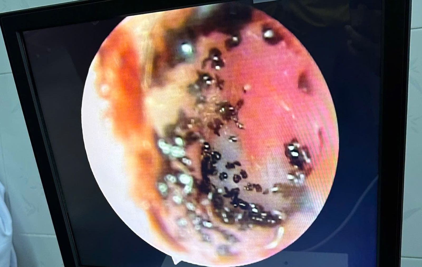 Endoscopic image of a child's ear shows a swarm of parasitic mites inside. Photo: Dakrong District Medical Center.