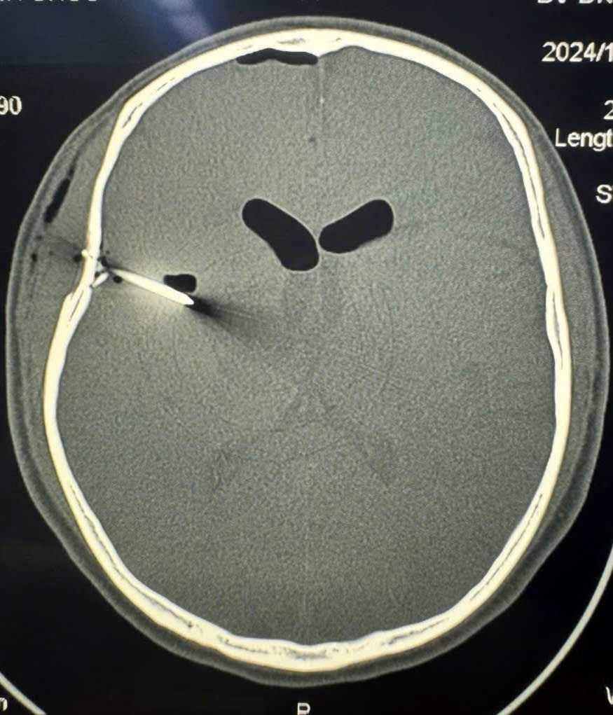 CT scan of the brain shows a metal foreign object penetrating the brain. Photo: BVCC
