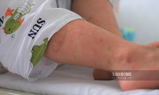 Biểu hiện bệnh sởi trên da của bệnh nhi. Ảnh: Phong Linh.