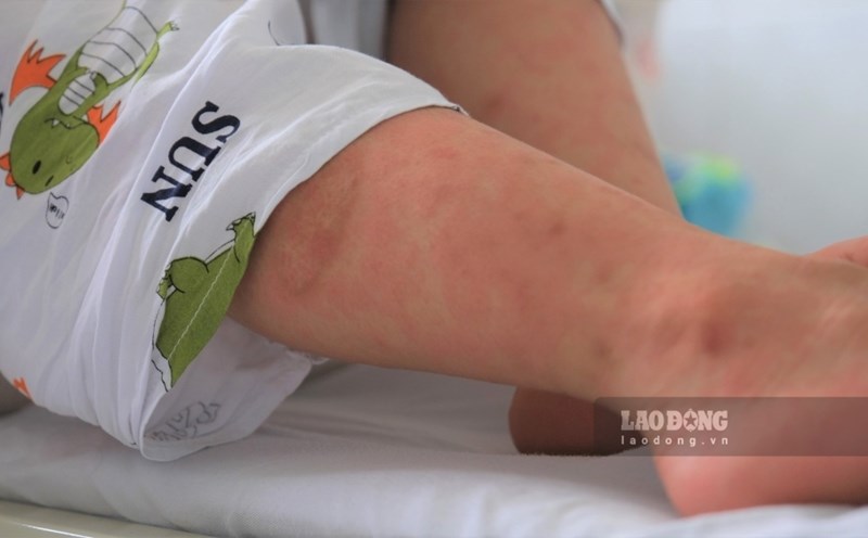 Measles symptoms on the skin of a child. Photo: Phong Linh.