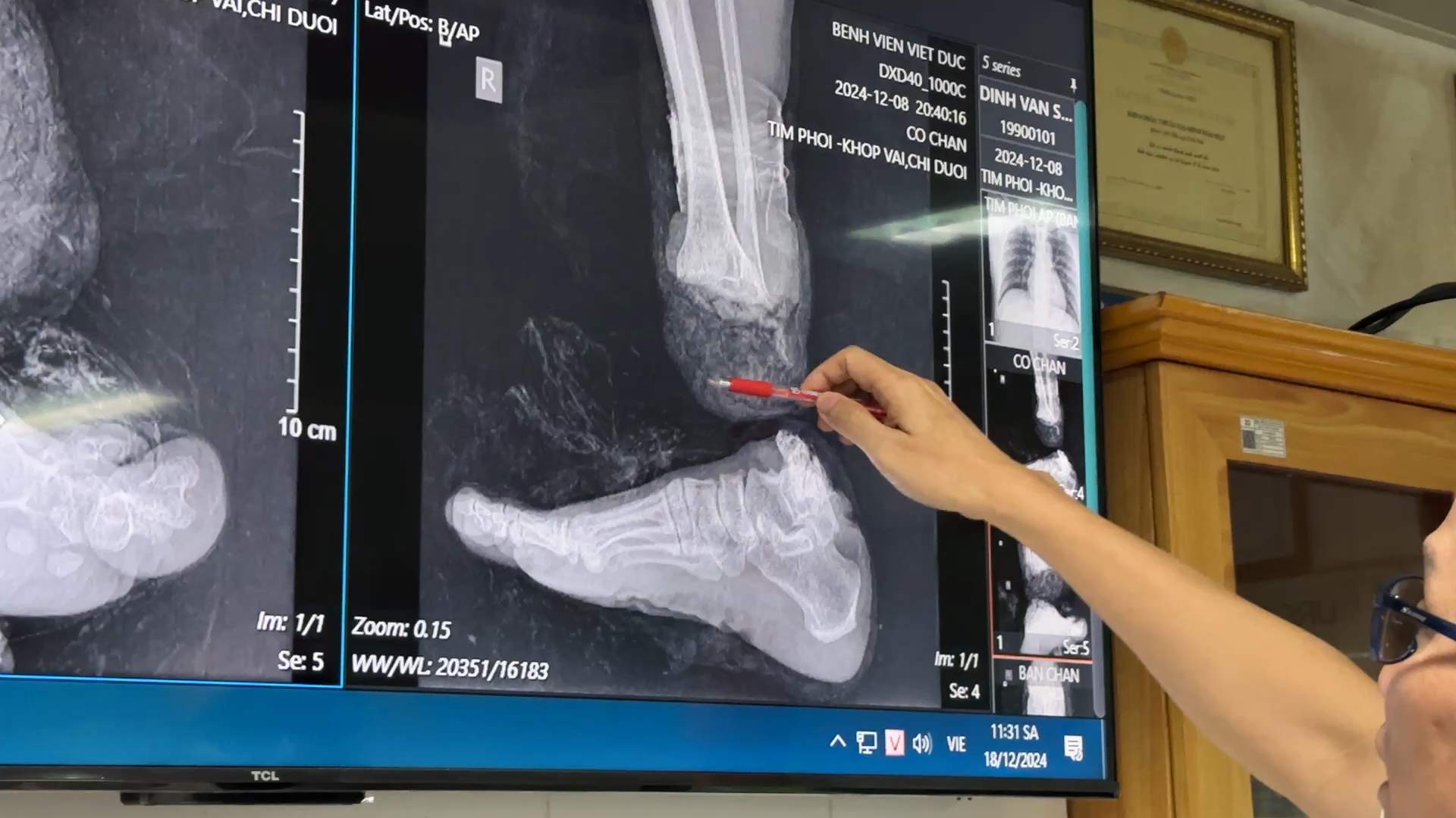 Image of a patient's severed ankle. Photo: BVCC