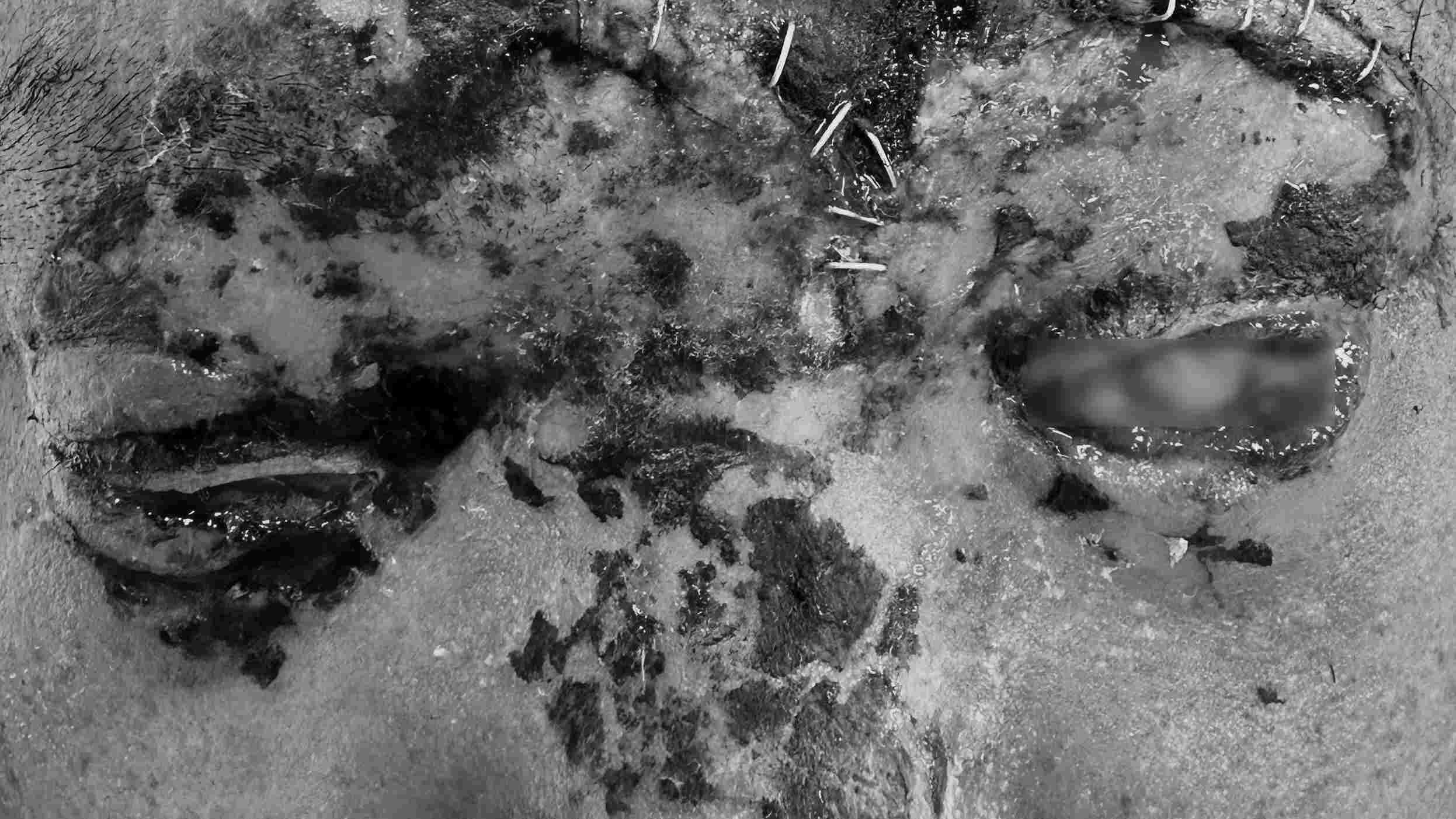 Image of facial and eye injuries on the 10th day of treatment of a victim due to artillery fire at 108 Central Military Hospital. Photo: BSCC