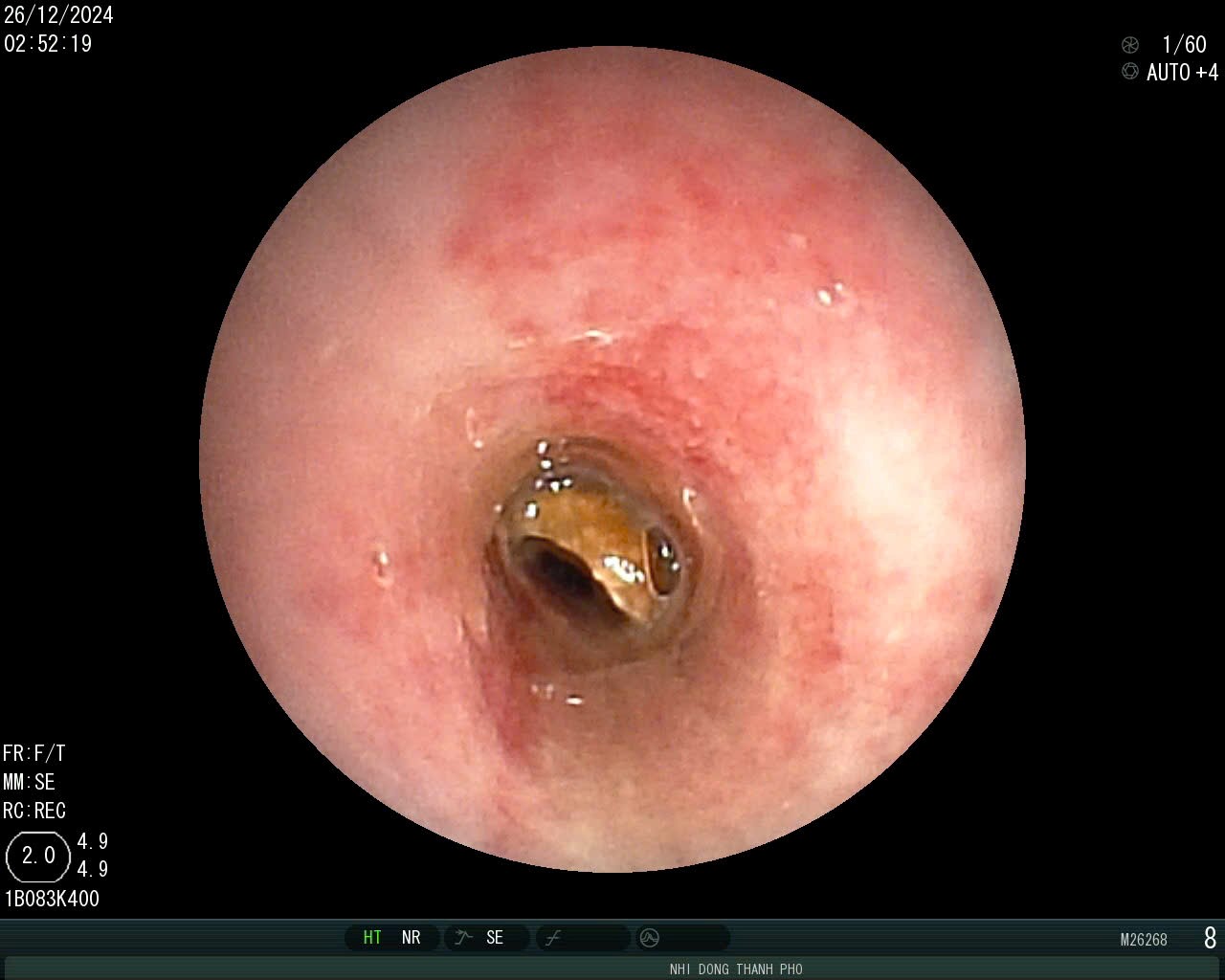 Foreign object bean stuck in the airway of a child patient. Photo: Provided by doctor