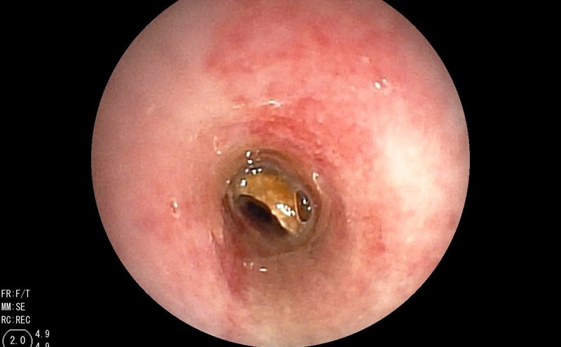 Foreign object bean stuck in the airway of a child patient. Photo: Provided by doctor