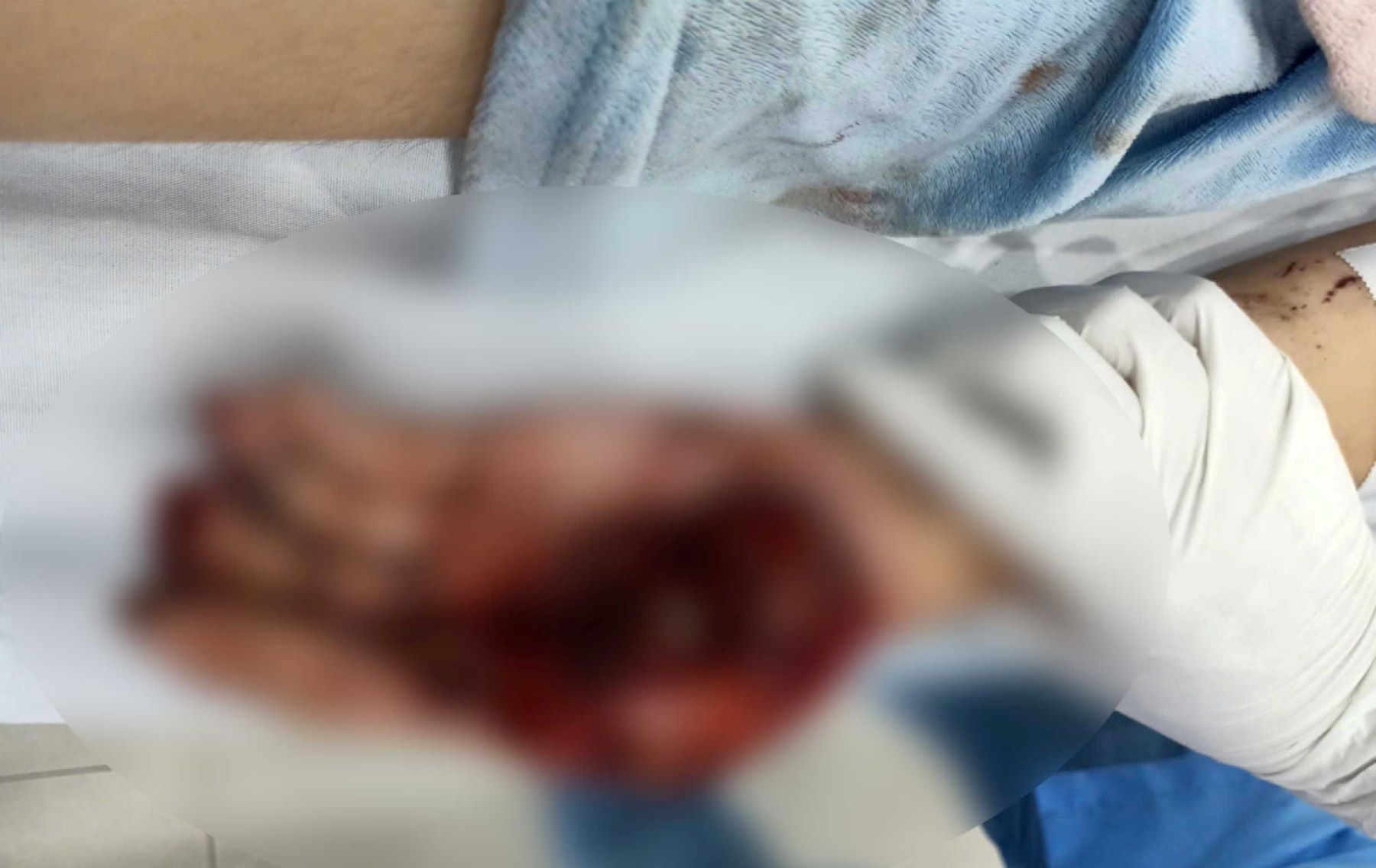 Child patient playing with firecrackers exploded and hit both hands. Photo: BVCC