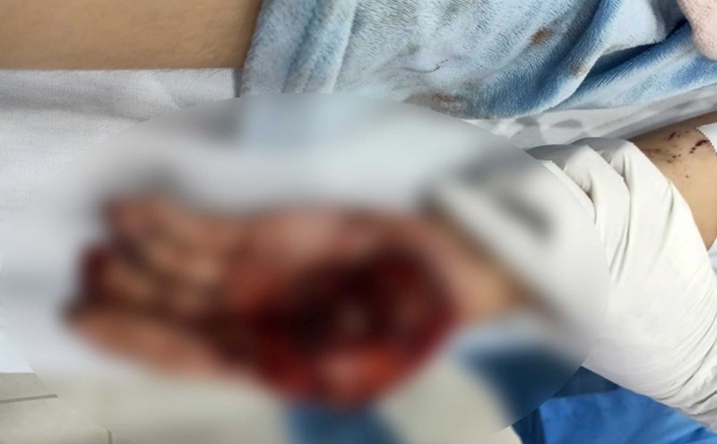 Child patient playing with firecrackers exploded and hit both hands. Photo: BVCC