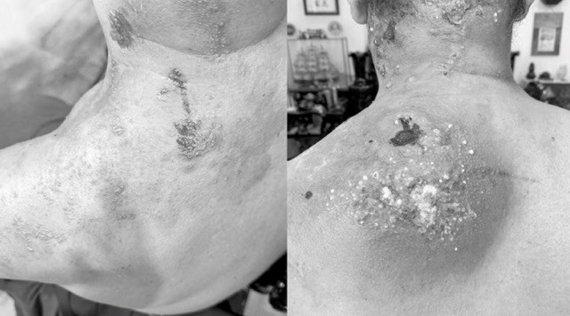 Post-herpetic neuralgia can last for weeks. Photo: BSCC