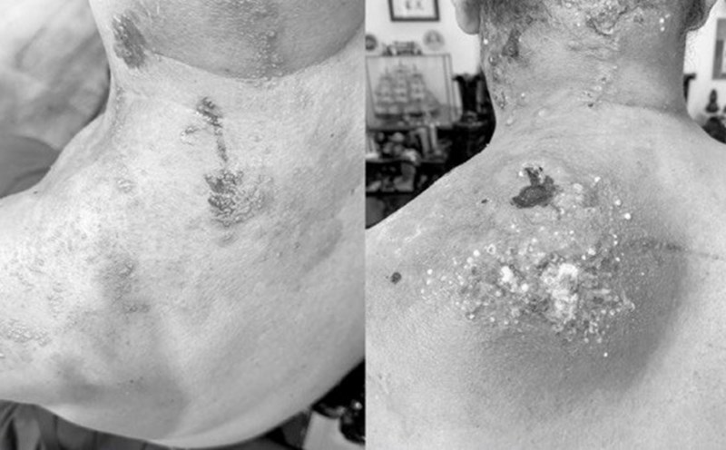 Post-herpetic neuralgia can last for weeks. Photo: BSCC