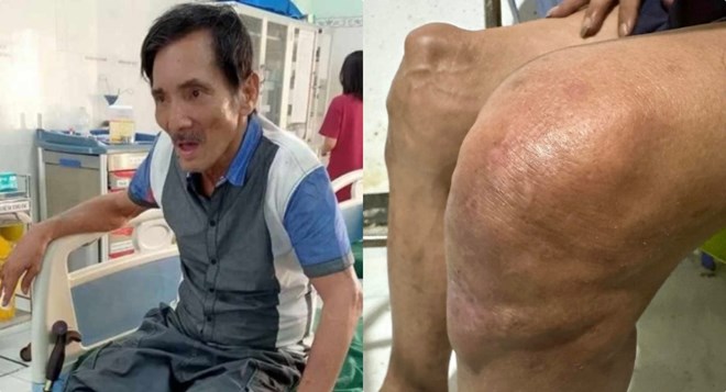 Thương Tín viêm khớp nặng phải nhập viện