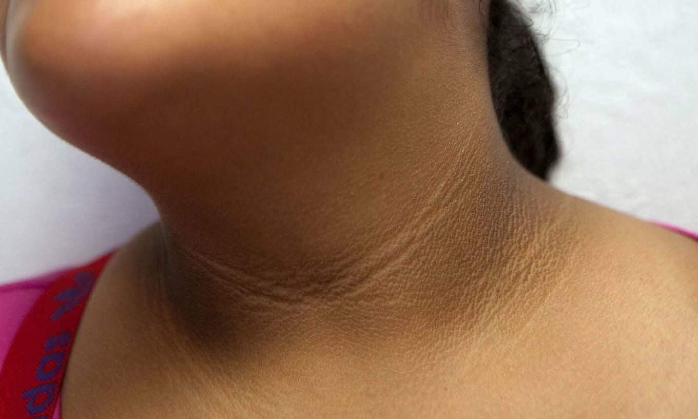 Hội chứng gai đen cảnh báo tăng đường huyết. Ảnh: BSCC