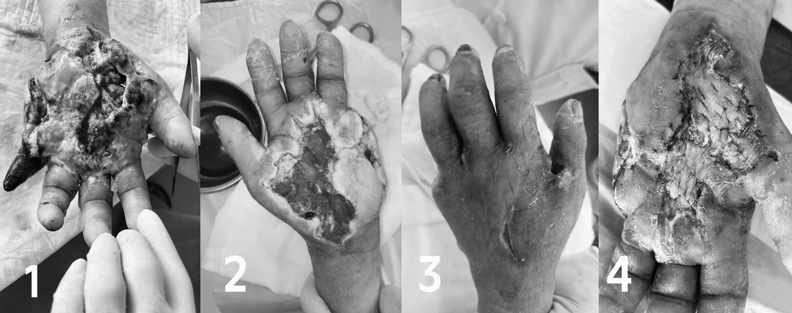 Risk of losing a hand from staphylococcal cellulitis. Photo: BVCC