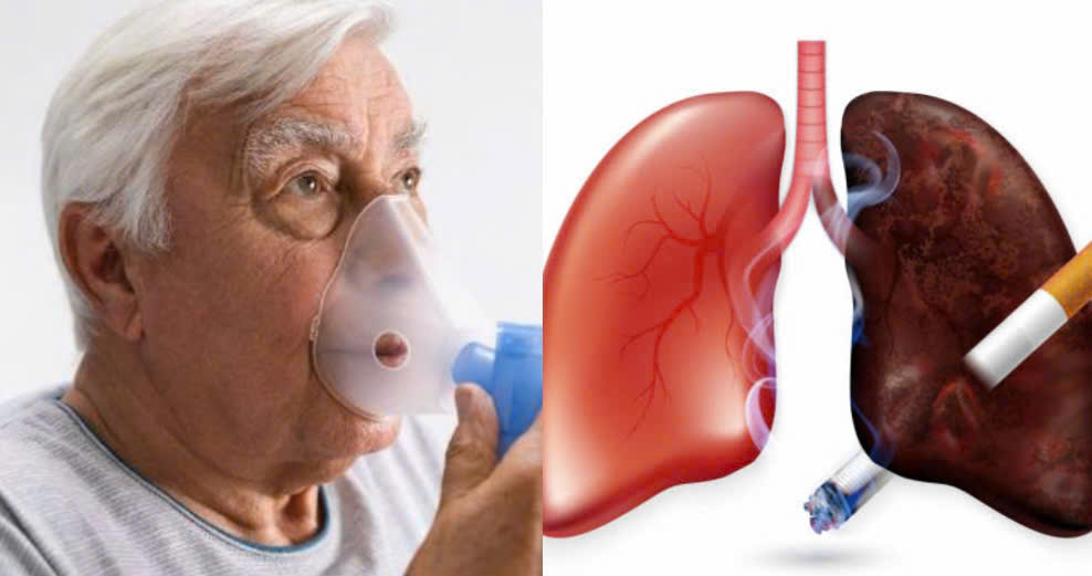 The leading cause of COPD is tobacco. Graphics: Huong Giang