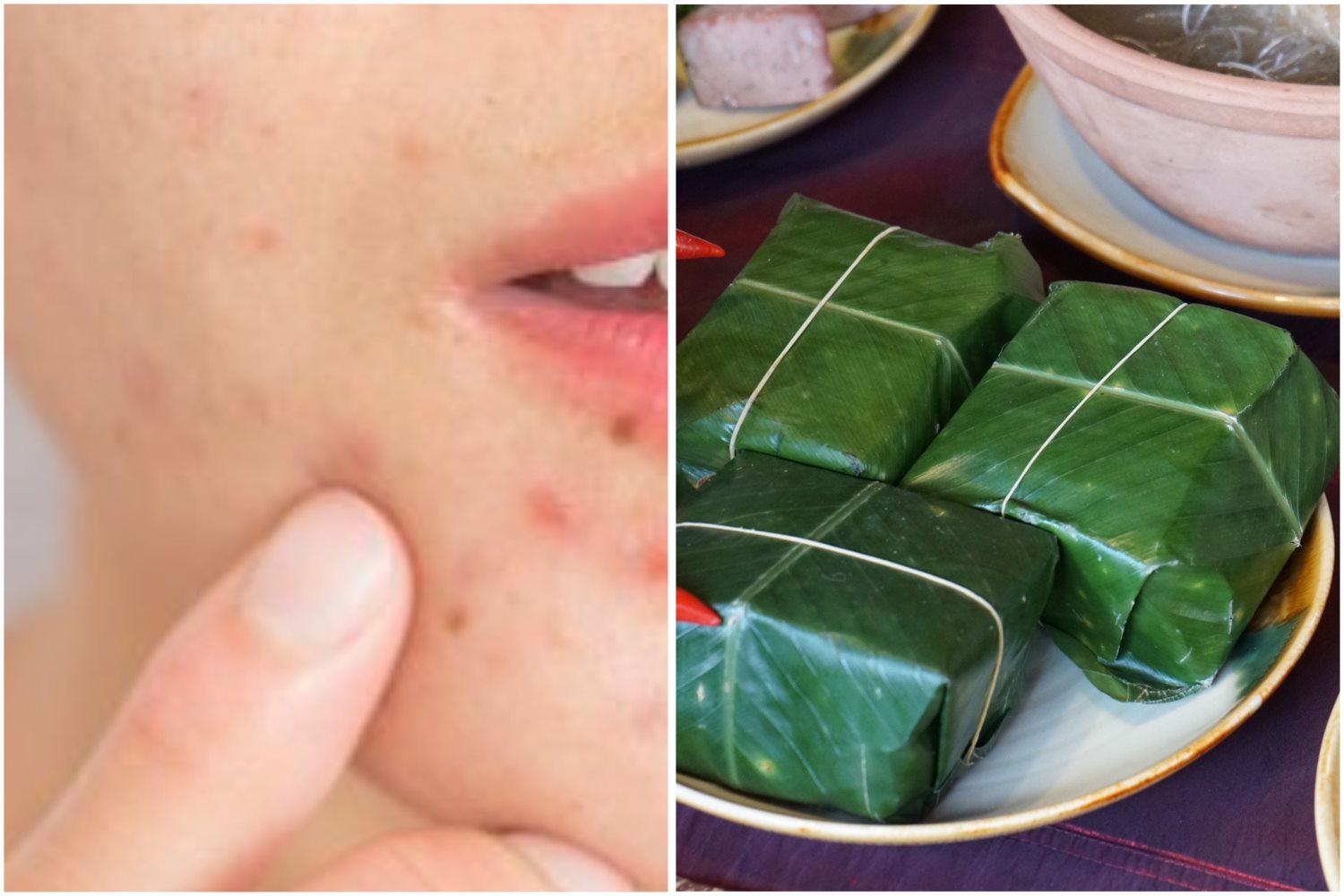 Chế độ ăn uống chứa nhiều đường và thói quen sinh hoạt thất thường dịp Tết có thể làm da bị xấu đi, nổi mụn. Đồ họa: Thanh Thanh 