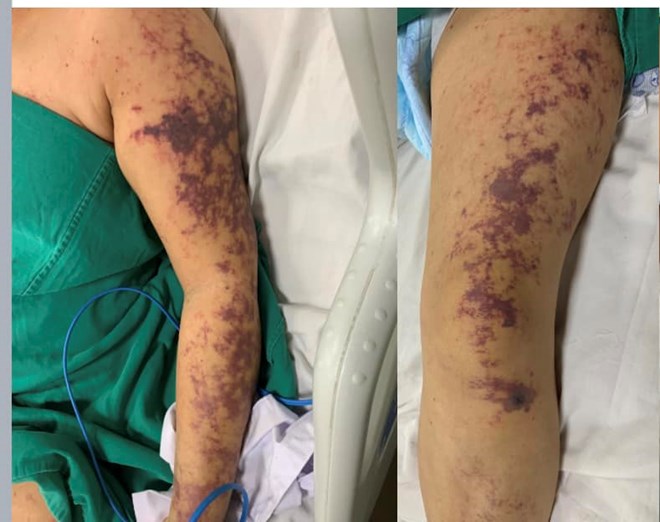 Mảng tím đen trên da vùng do mắc liên cầu lợn. Ảnh minh hoạ: Bệnh viện Nhiệt đới Trung ương cung cấp