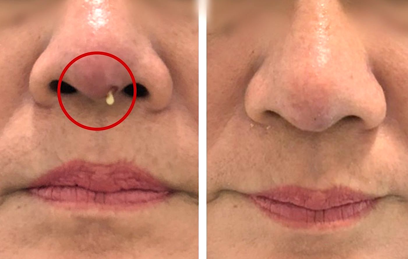 Hình ảnh trước và sau khi bệnh nhân điều trị biến chứng nhiễm trùng áp xe sau nâng mũi tại Bệnh viện Hoàn Mỹ Cửu Long (TP Cần Thơ). Ảnh: BVCC